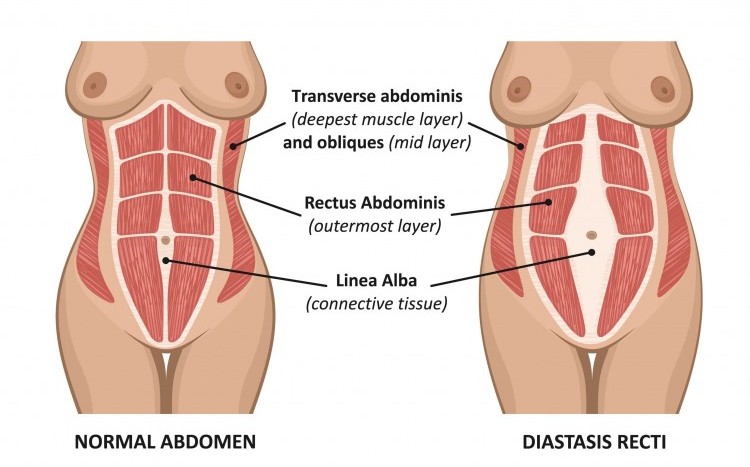 Os abdominais hipopressivos e a diástase
